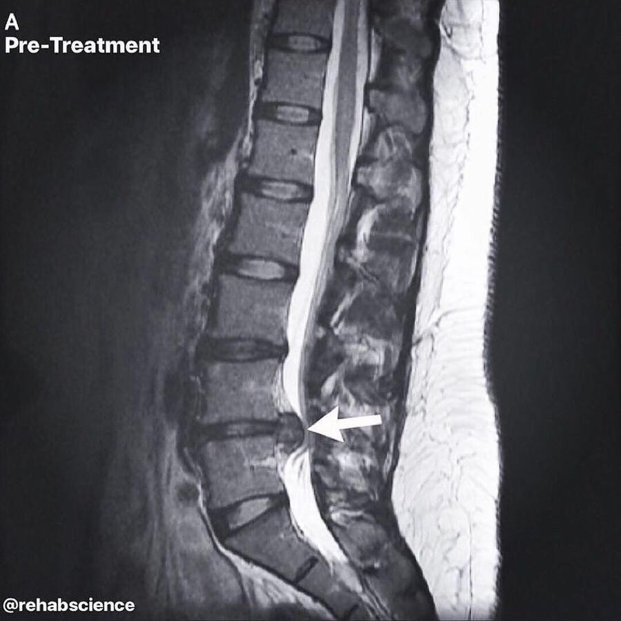 Spinal Disc Decompression Inver Grove Heights, MN Spinal Disc Decompression Inver Grove Heights, MN