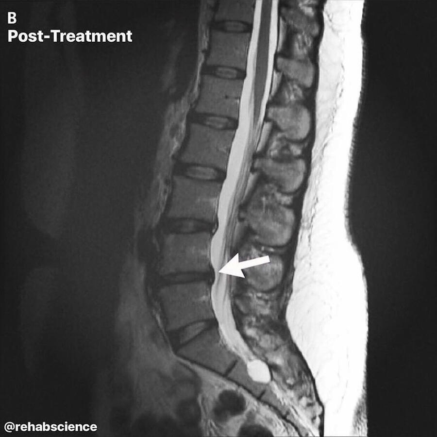 Spinal Disc Decompression in Inver Grove Heights, MN Spinal Disc Decompression in Inver Grove Heights, MN
